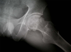 수술 전 고관절 X-선